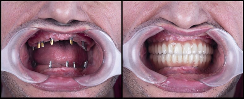 Up Too Close and Personal with Dental Implants